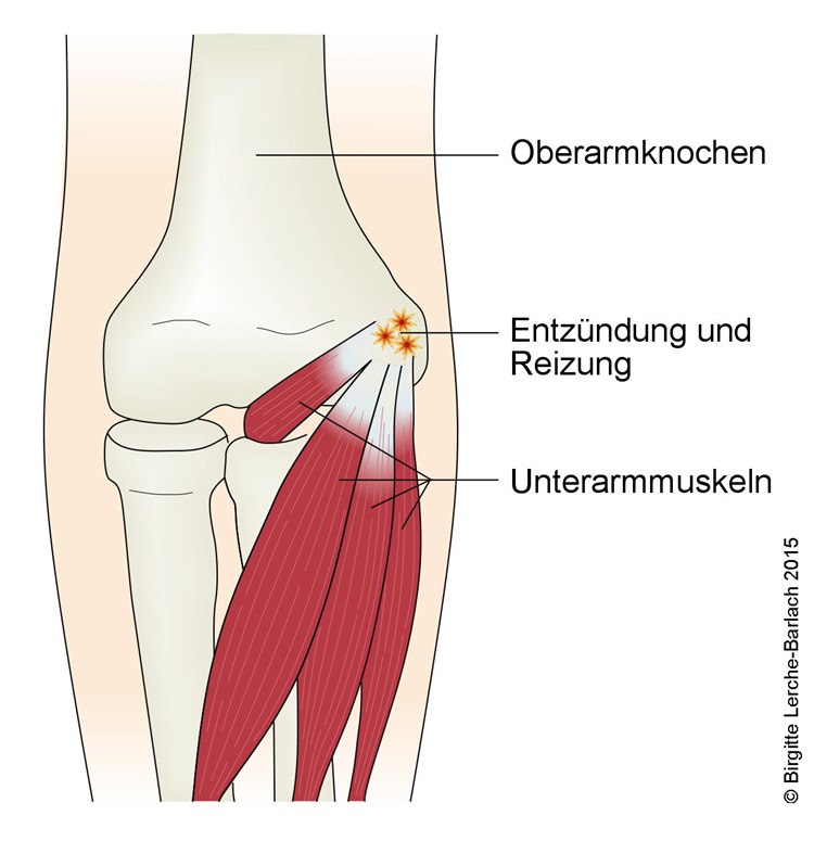 Epicondylitis medialis Epicondylitis medialis