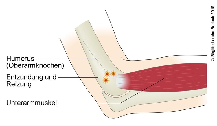 Epicondylitis lateralis Epicondylitis lateralis