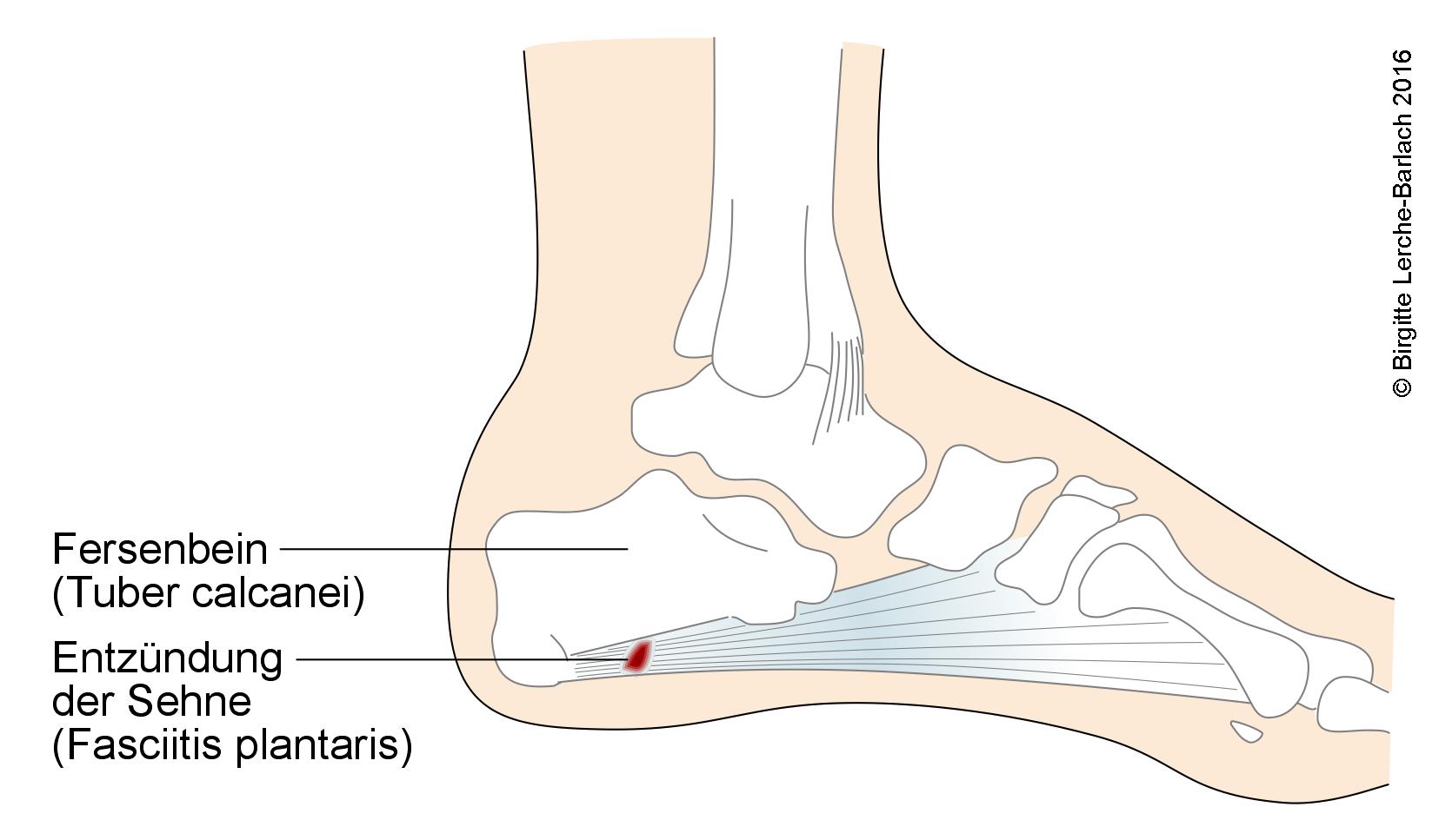 Plantarfasziitis, Seitenenansicht Plantare Fasciitis, Seitenansicht