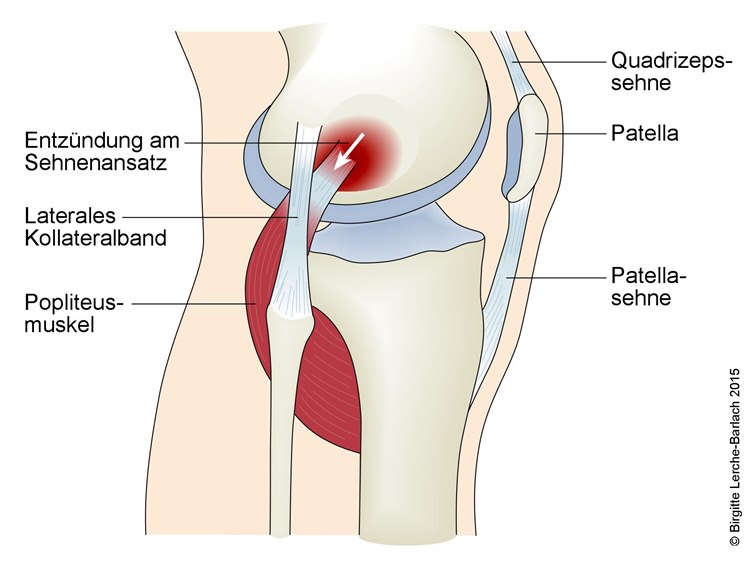Popliteus-Tendinopathie Popliteus-Tendinopathie