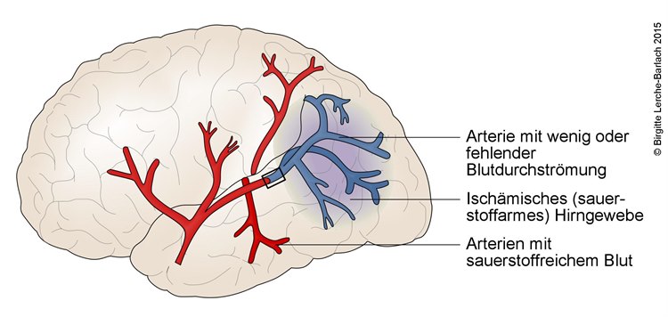 Hirninfarkt (Schlaganfall durch Gefäßverschluss) Hirninfarkt (Schlaganfall durch Gefäßverschluss)