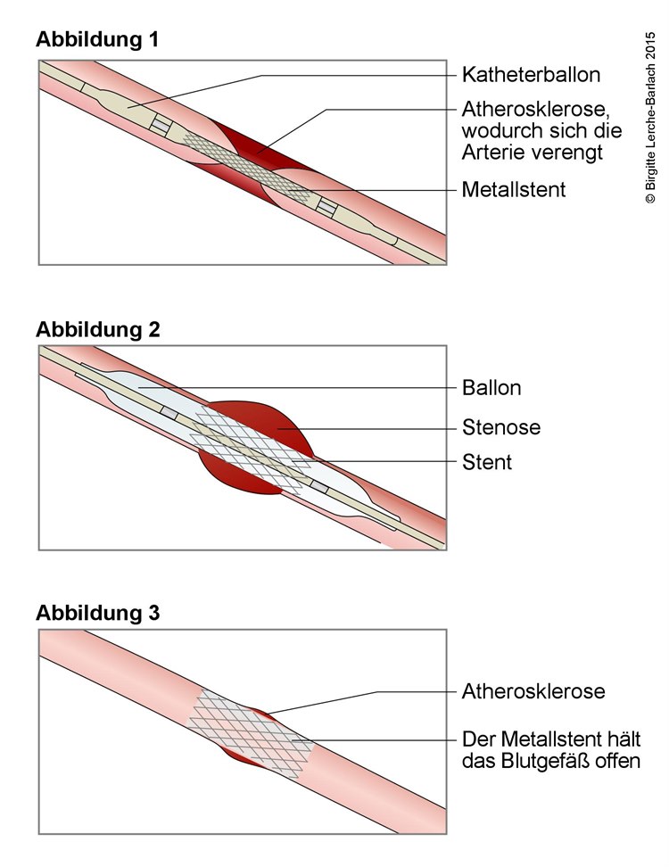 Stentbehandlung an einem verengten Blutgefäß Stentbehandlung an einem verengten Blutgefäß