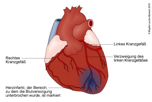 Herzinfarkt durch Verschluss des linken Herzkranzgefäßes Herzinfarkt durch Verschluss des linken Herzkranzgefäßes