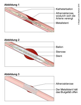 Stentbehandlung bei verengtem Blutgefäß Stentbehandlung bei verengtem Blutgefäß