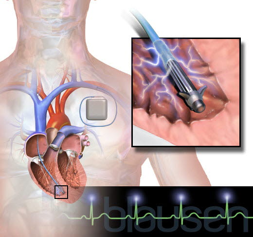 ICD: implantierbarer Kardioverter-Defibrillator ICD: implantierbarer Kardioverter-Defibrillator