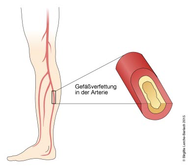 Arteriosklerose der Beinarterien Arteriosklerose der Beinarterien