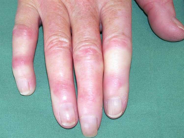 Raynaud-Syndrom Raynaud-Syndrom