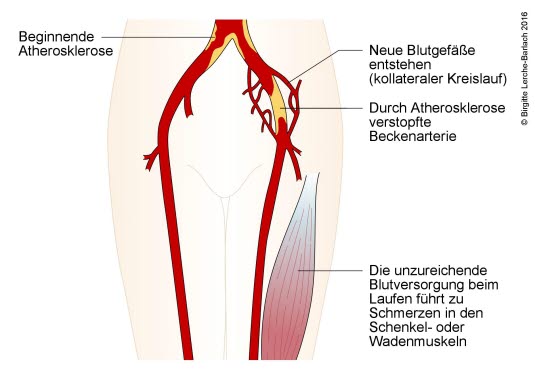 Claudicatio intermittens Claudicatio intermittens