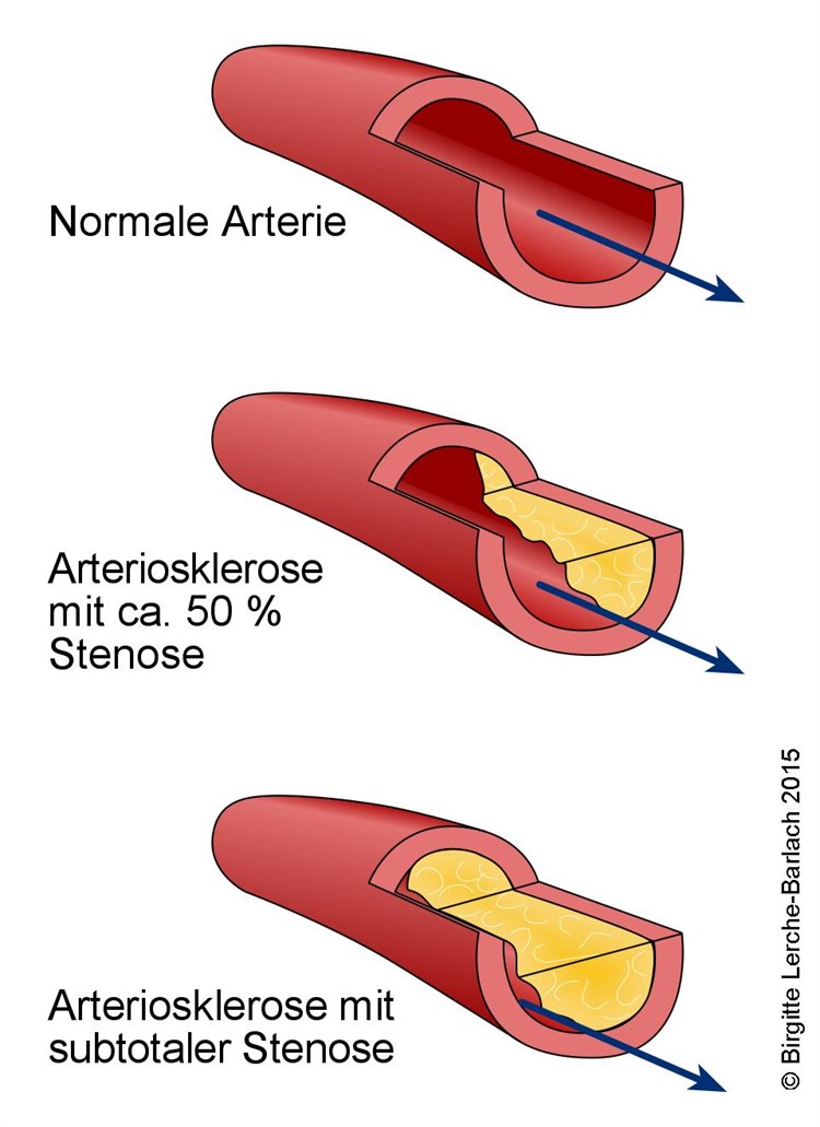Entwicklung einer Arteriosklerose Entwicklung einer Arteriosklerose
