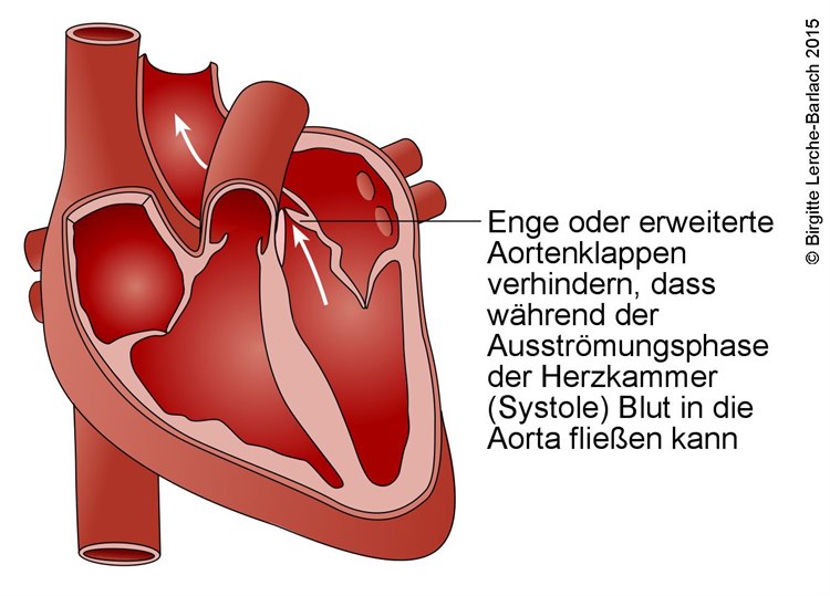 Aortenstenose Aortenstenose