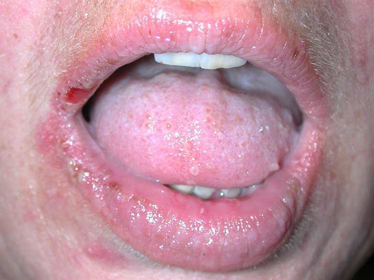 Pemphigus Pemphigus