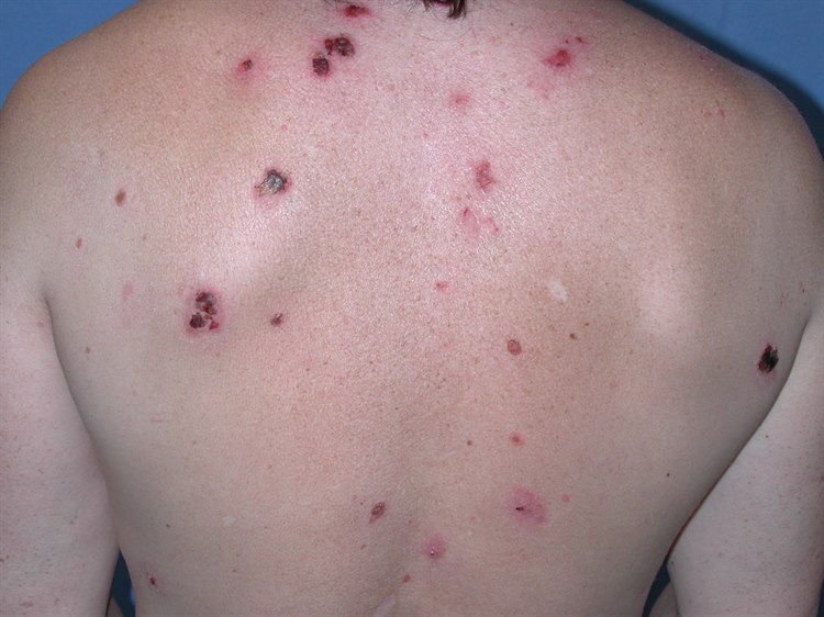 Pemphigus Pemphigus