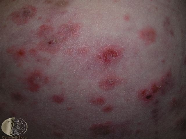 Pemphigoid