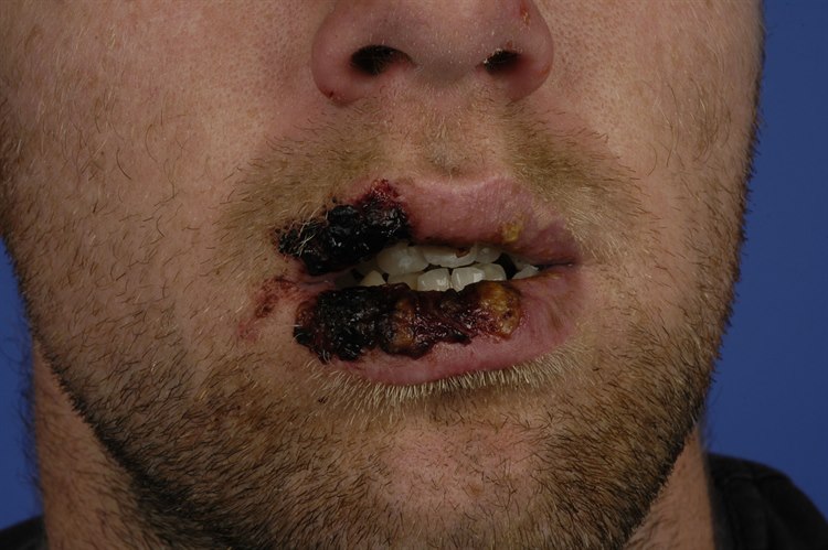 Das Stevens-Johnson-Syndrom ist gekennzeichnet durch schwere Krankheitsauswirkungen mit Erythrodermie und Epidermolysis sowie Beteiligung der Schleimhäute. Das Stevens-Johnson-Syndrom ist gekennzeichnet durch schwere Krankheitsauswirkungen mit Erythrodermie und Epidermolysis sowie Beteiligung der Schleimhäute.