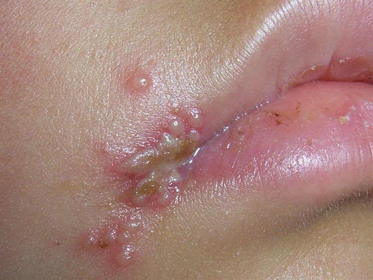 Herpes simplex, Lippenbläschen Herpes simplex labialis