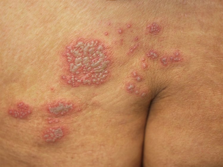 Zoster: Typisch sind Schmerzen, Bläschen und Hautrötung. Zoster: Typisch sind Schmerzen, Bläschen und Hautrötung.