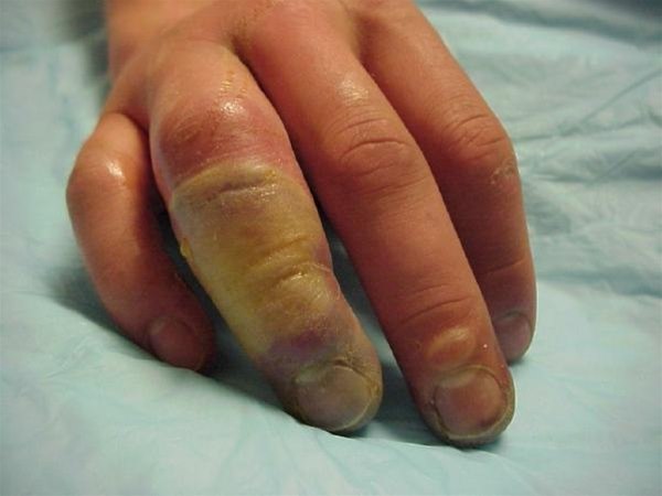 Erfrierung Erfrierung