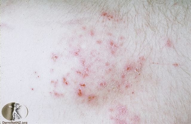 Dermatitis herpetiformis