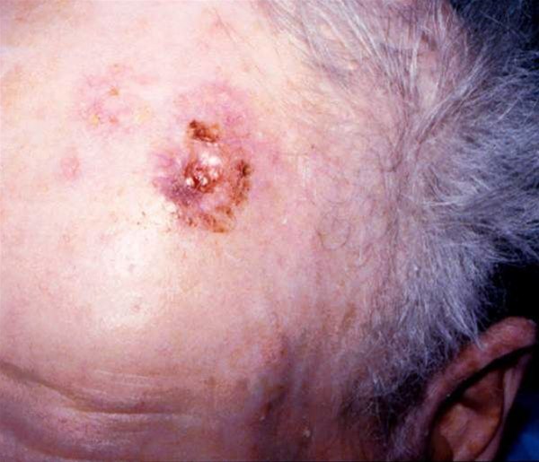 Plattenepithelkarzinom 277-2-plateepitelcarcinom.jpg