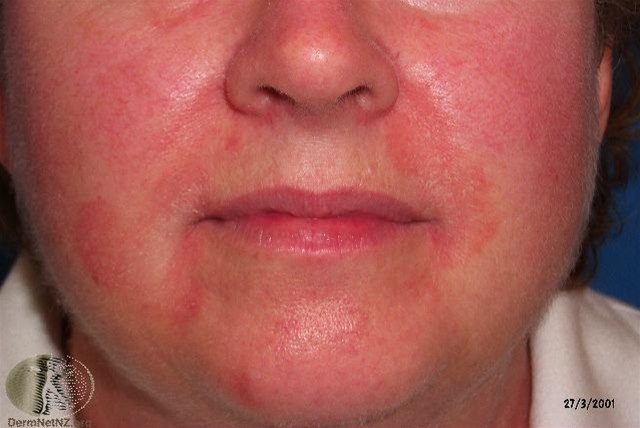 Seborrhoisches Ekzem