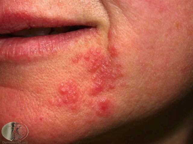 Periorale Dermatitis