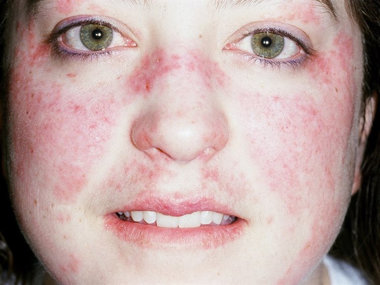 Schmetterlingsflechte