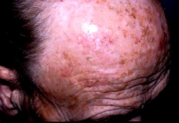 Aktinische Keratose