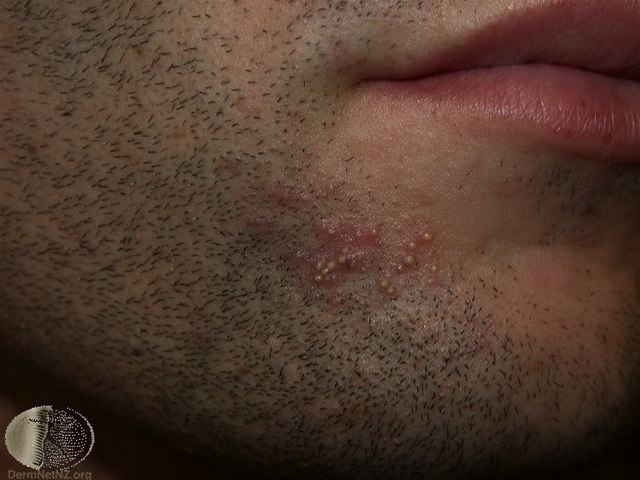 Follikulitis nach der Rasur Follikulitis nach der Rasur