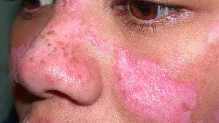 Diskoider Lupus erythematodes Diskoider Lupus erythematodes: scharf begrenzte, gerötete und schuppende Plaques im Gesicht.