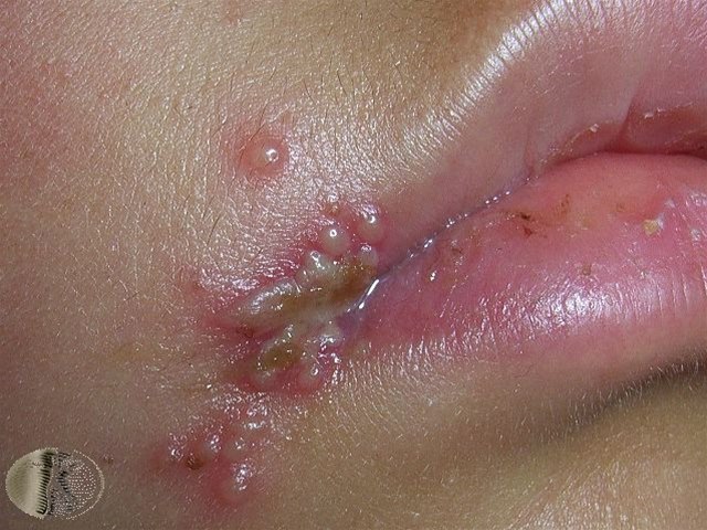 Lippenbläschen bei Herpes