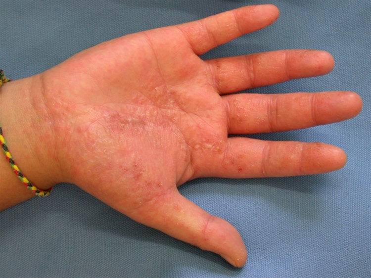 Dyshidrosis, Pompholyx an der Handfläche Dyshidrosis, Pompholyx an der Handfläche