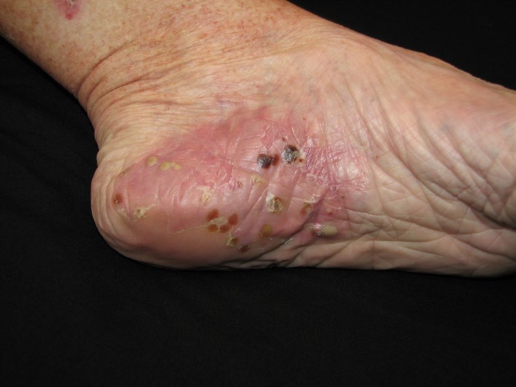 Pustulosis palmoplantaris Psoriasis pustulosa palmoplantaris