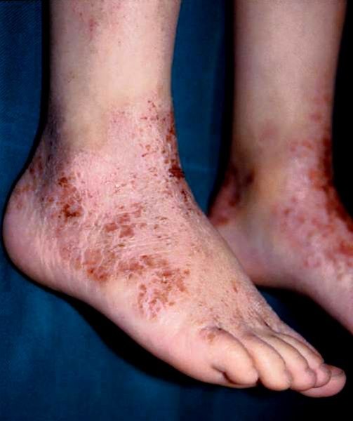Kontaktdermatitis Kontaktdermatitis