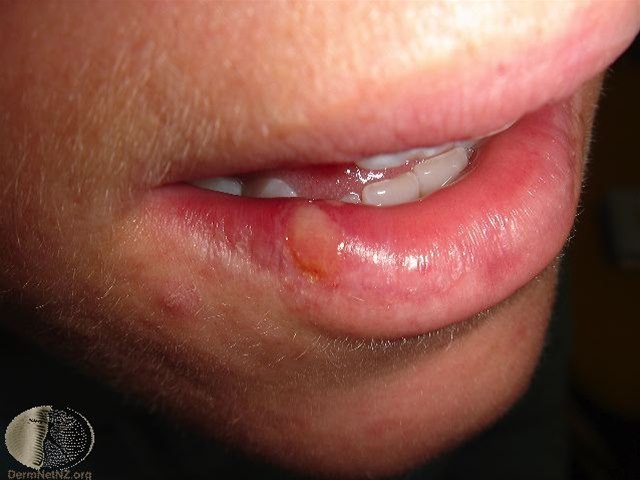 Herpes simplex, Herpes labialis 1 Herpes simplex, Herpes labialis 1