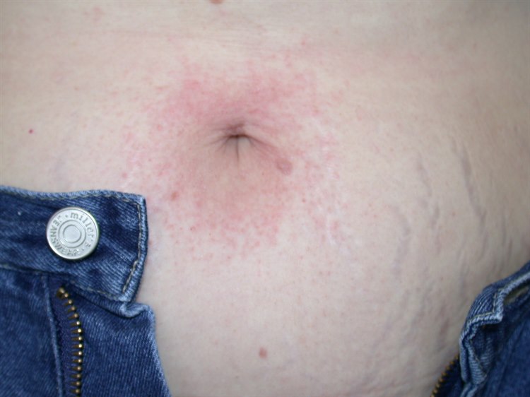 Allergische Kontaktdermatitis Allergische Kontaktdermatitis