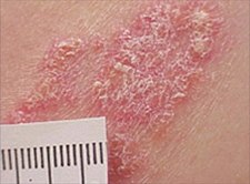 Psoriasis, plaque 1565-2-psoriasis-plakk