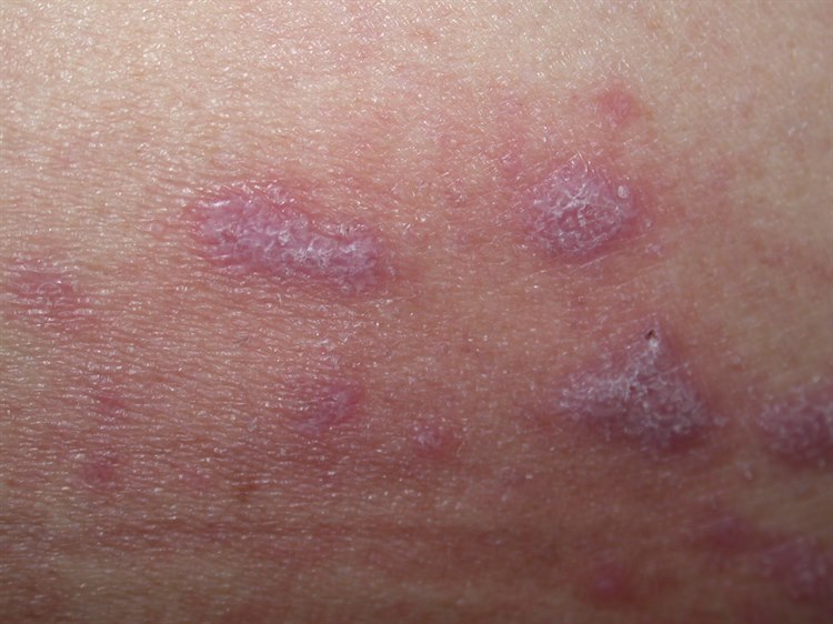 Lichen ruber Lichen ruber