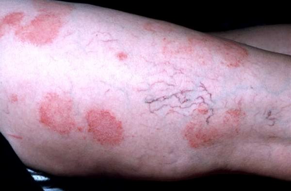 Nummuläres Ekzem Nummuläres Ekzem