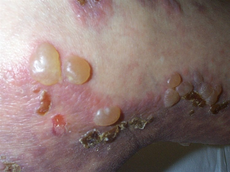 Bullöses Pemphigoid Bullöses Pemphigoid