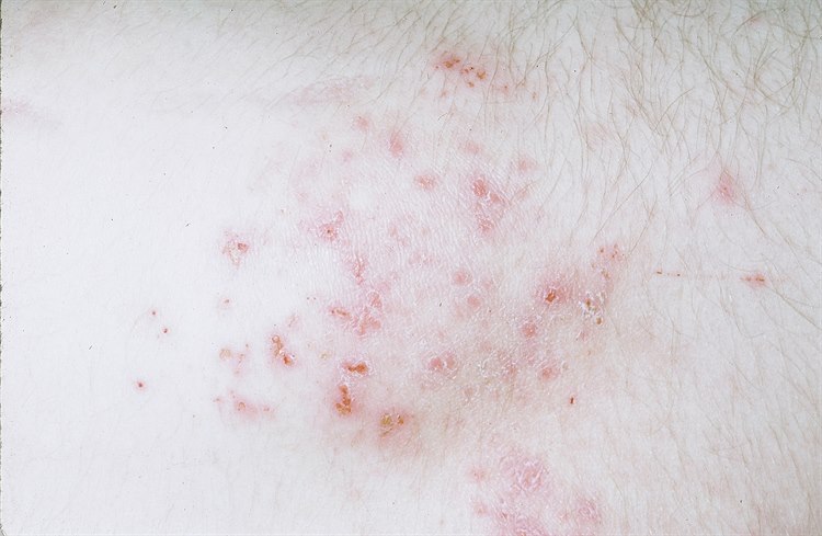 Dermatitis herpetiformis Dermatitis herpetiformis
