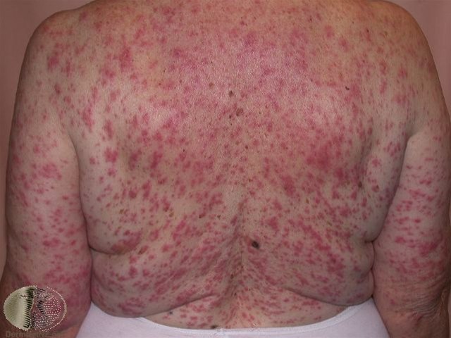 Drug eruption, mobiliform 4123-2-medikamentelle-eksantemer-morbiliform