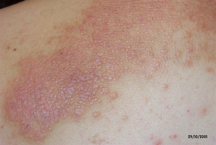 Neurodermitis Neurodermitis