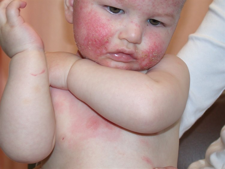 Kinderekzem (atopisches Ekzem) Kinderekzem (atopisches Ekzem)