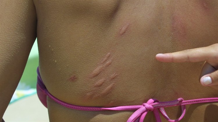 Mückenstiche Mückenstiche