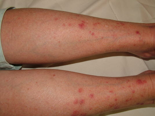 Polymorphe Lichtdermatose (Sonnenekzem) Polymorphe Lichtdermatose (Sonnenekzem)