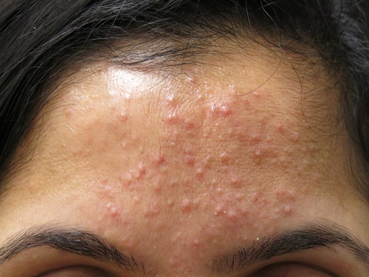 Acne papulopustulosa – gering bis mäßig ausgeprägt Acne papulopustulosa – gering bis mäßig ausgeprägt