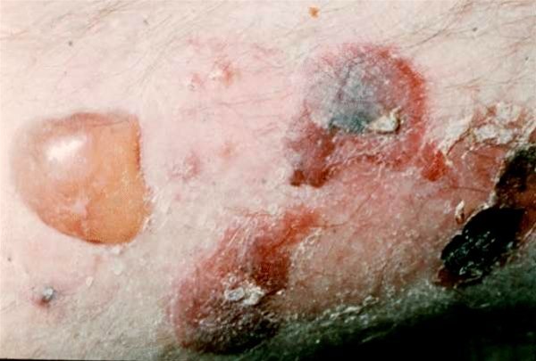 Bulla (Blase) – mit Flüssigkeit gefüllte Hautblase, 1–5 cm im Durchmesser.