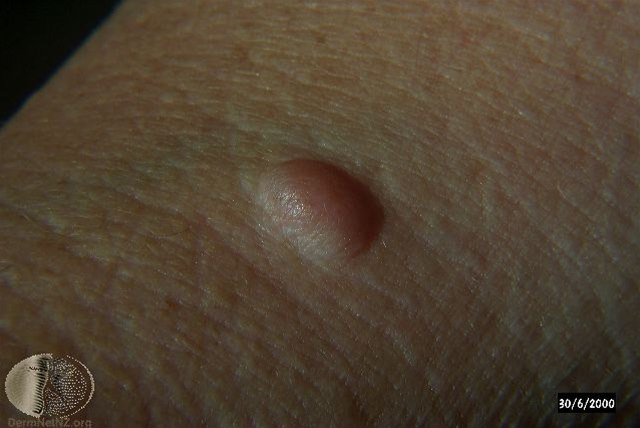 Nodulus (Tumor) – ein kleiner Knoten in der Haut, größer als eine Papel (> 1 cm).