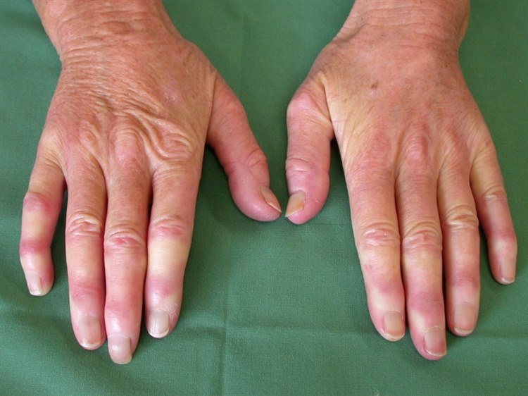 Raynaud-Syndrom Raynaud-Syndrom