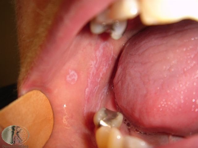 Lichen planus in der Mundhöhle 4098-2-lichen-planus-munn.jpg